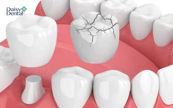 Giải Mã Giấc Mơ Thấy Làm Răng Mới: Ý Nghĩa, Điềm Tốt Xấu Và Các Trường Hợp Phổ Biến Giải Mã Giấc Mơ Thấy Làm Răng Mới: Ý Nghĩa, Điềm Tốt Xấu Và Các Trường Hợp Phổ Biến