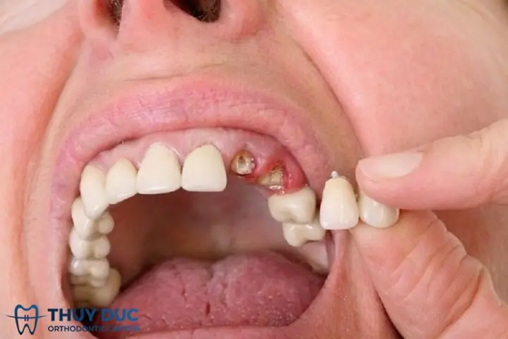 Giải Mã Ý Nghĩa Nằm Mơ Thấy Rụng Nhiều Răng: Điềm Báo Và Con Số Liên Quan