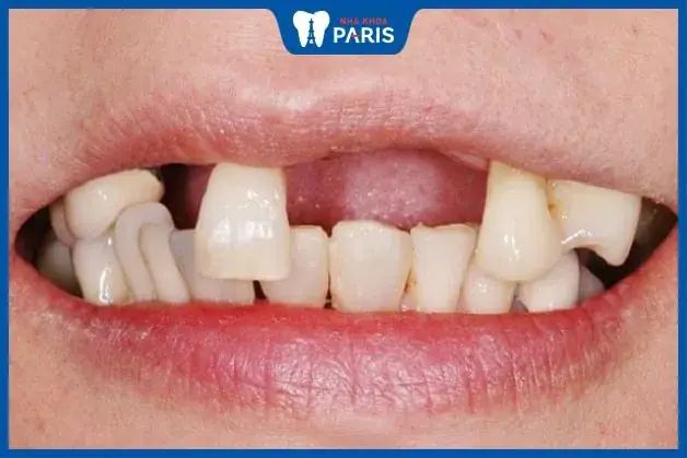 Giải Mã Ý Nghĩa Nằm Mơ Thấy Rụng Nhiều Răng: Điềm Báo Và Con Số Liên Quan