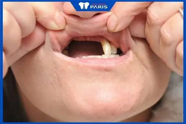 Giải Mã Ý Nghĩa Nằm Mơ Thấy Rụng Nhiều Răng: Điềm Báo Và Con Số Liên Quan