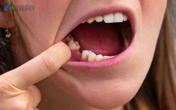 Nằm Mơ Thấy Rụng Răng Hàm Dưới: Ý Nghĩa, Dự Báo Và Cách Giải Thích Chi Tiết Nằm Mơ Thấy Rụng Răng Hàm Dưới: Ý Nghĩa, Dự Báo Và Cách Giải Thích Chi Tiết