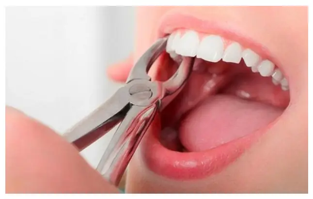 Giải Đáp Thực Hư: Nhổ Răng Có Ảnh Hưởng Đến Tướng Số Hay Chỉ Là Quan Niệm Dân Gian? Giải Đáp Thực Hư: Nhổ Răng Có Ảnh Hưởng Đến Tướng Số Hay Chỉ Là Quan Niệm Dân Gian?