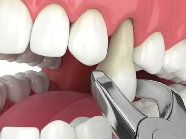 Giải Đáp Thực Hư: Nhổ Răng Có Ảnh Hưởng Đến Tướng Số Hay Chỉ Là Quan Niệm Dân Gian? Giải Đáp Thực Hư: Nhổ Răng Có Ảnh Hưởng Đến Tướng Số Hay Chỉ Là Quan Niệm Dân Gian?