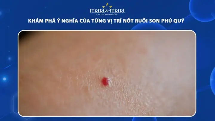 Tổng Hợp Những Vị Trí Nốt Ruồi Phú Quý Trên Mặt Và Cơ Thể Cho Nam Nữ