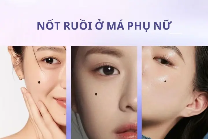 Những Vị Trí Nốt Ruồi Trên Mặt Nên Xóa Theo Nhân Tướng Học Và Y Khoa