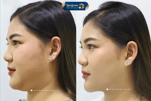Giải Mã Tướng Số Nọng Cằm (hai Cằm): Ý Nghĩa Nam - Nữ, Tốt - Xấu Và Diễn Biến Vận Mệnh