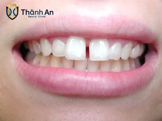 Giải Mã Tướng Số Răng Cửa Thưa: Ý Nghĩa Vận Mệnh, Tốt Xấu Và Cách Khắc Phục Hiệu Quả Giải Mã Tướng Số Răng Cửa Thưa: Ý Nghĩa Vận Mệnh, Tốt Xấu Và Cách Khắc Phục Hiệu Quả