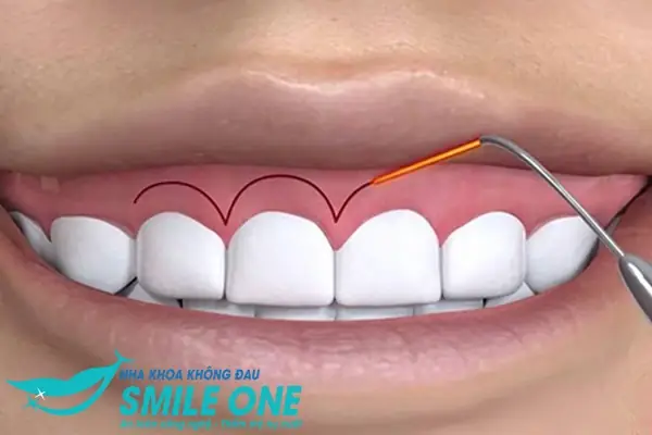 Giải Mã Răng Ngắn Cười Hở Lợi Tướng Số: Ý Nghĩa Nhân Tướng Học Và Cách Khắc Phục