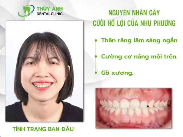 Giải Mã Răng Ngắn Cười Hở Lợi Tướng Số: Ý Nghĩa Nhân Tướng Học Và Cách Khắc Phục