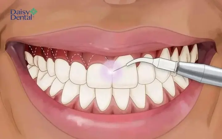 Giải Mã Răng Ngắn Cười Hở Lợi Tướng Số: Ý Nghĩa Nhân Tướng Học Và Cách Khắc Phục