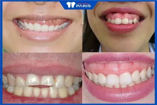 Giải Mã Răng Ngắn Cười Hở Lợi Tướng Số: Ý Nghĩa Nhân Tướng Học Và Cách Khắc Phục