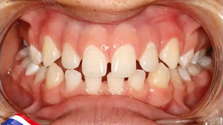 Giải Mã Tướng Số Răng Thưa Hàm Dưới: Ý Nghĩa Vận Mệnh Và Đặc Điểm Nhân Tướng Học Giải Mã Tướng Số Răng Thưa Hàm Dưới: Ý Nghĩa Vận Mệnh Và Đặc Điểm Nhân Tướng Học