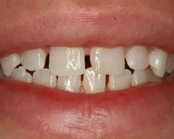 Giải Mã Tướng Số Răng Thưa Hàm Dưới: Ý Nghĩa Vận Mệnh Và Đặc Điểm Nhân Tướng Học Giải Mã Tướng Số Răng Thưa Hàm Dưới: Ý Nghĩa Vận Mệnh Và Đặc Điểm Nhân Tướng Học