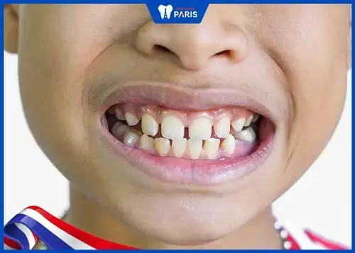 Giải Mã Tướng Số Răng Thưa Hàm Dưới: Ý Nghĩa Vận Mệnh Và Đặc Điểm Nhân Tướng Học Giải Mã Tướng Số Răng Thưa Hàm Dưới: Ý Nghĩa Vận Mệnh Và Đặc Điểm Nhân Tướng Học