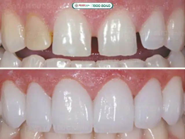 Giải Mã Tướng Số Răng Thưa: Ý Nghĩa Vận Mệnh, Tính Cách Nam/nữ, Tốt Xấu & Cách Khắc Phục Giải Mã Tướng Số Răng Thưa: Ý Nghĩa Vận Mệnh, Tính Cách Nam/nữ, Tốt Xấu & Cách Khắc Phục
