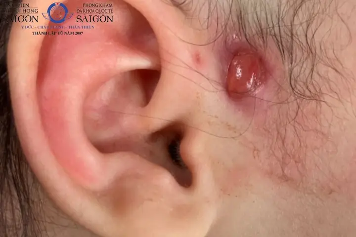 Giải Mã Ý Nghĩa Rò Luân Nhĩ Tướng Số: Điềm Báo Gì Cho Nam/nữ, Trái/phải Và Thực Tế Y Khoa Giải Mã Ý Nghĩa Rò Luân Nhĩ Tướng Số: Điềm Báo Gì Cho Nam/nữ, Trái/phải Và Thực Tế Y Khoa