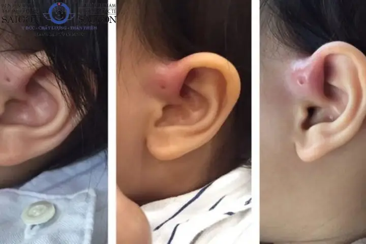 Giải Mã Ý Nghĩa Rò Luân Nhĩ Tướng Số: Điềm Báo Gì Cho Nam/nữ, Trái/phải Và Thực Tế Y Khoa Giải Mã Ý Nghĩa Rò Luân Nhĩ Tướng Số: Điềm Báo Gì Cho Nam/nữ, Trái/phải Và Thực Tế Y Khoa