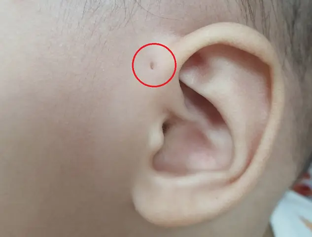 Giải Mã Ý Nghĩa Rò Luân Nhĩ Tướng Số: Điềm Báo Gì Cho Nam/nữ, Trái/phải Và Thực Tế Y Khoa Giải Mã Ý Nghĩa Rò Luân Nhĩ Tướng Số: Điềm Báo Gì Cho Nam/nữ, Trái/phải Và Thực Tế Y Khoa