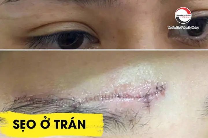 Giải Mã Ý Nghĩa Sẹo Ở Mũi Tướng Số: Vị Trí Tốt/xấu & Cách Khắc Phục Hiệu Quả