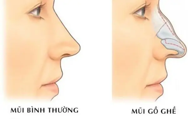 Sống Mũi Gồ Trong Nhân Tướng Học Nam Giới: Ý Nghĩa Vận Mệnh Và Tính Cách