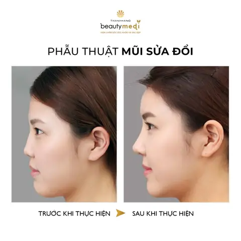 Sửa Mũi Có Ảnh Hưởng Tới Tướng Số Không Và Góc Nhìn Khoa Học Về Phong Thủy Sửa Mũi Có Ảnh Hưởng Tới Tướng Số Không Và Góc Nhìn Khoa Học Về Phong Thủy
