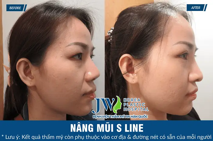 Sửa Mũi Có Ảnh Hưởng Tới Tướng Số Không Và Góc Nhìn Khoa Học Về Phong Thủy Sửa Mũi Có Ảnh Hưởng Tới Tướng Số Không Và Góc Nhìn Khoa Học Về Phong Thủy