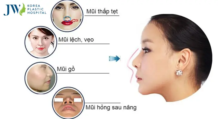 Giải Đáp Sửa Mũi Có Phá Tướng Không Theo Góc Độ Khoa Học Và Tướng Số Giải Đáp Sửa Mũi Có Phá Tướng Không Theo Góc Độ Khoa Học Và Tướng Số