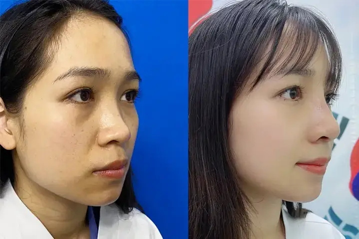 Giải Đáp Sửa Mũi Có Phá Tướng Không Theo Góc Độ Khoa Học Và Tướng Số Giải Đáp Sửa Mũi Có Phá Tướng Không Theo Góc Độ Khoa Học Và Tướng Số