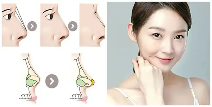 Giải Đáp Sửa Mũi Có Phá Tướng Không Theo Góc Độ Khoa Học Và Tướng Số Giải Đáp Sửa Mũi Có Phá Tướng Không Theo Góc Độ Khoa Học Và Tướng Số