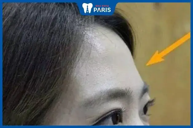 Giải Mã Tướng Số Trán Hóp 2 Bên: Ý Nghĩa Vận Mệnh Và Cách Khắc Phục Cho Người Quan Tâm Nhân Tướng Học Giải Mã Tướng Số Trán Hóp 2 Bên: Ý Nghĩa Vận Mệnh Và Cách Khắc Phục Cho Người Quan Tâm Nhân Tướng Học