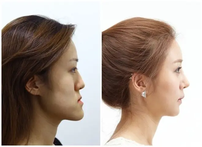 Xem Tướng Cằm Nhô Ra: Ý Nghĩa Tướng Số Nam Nữ & Cách Khắc Phục Hiệu Quả Xem Tướng Cằm Nhô Ra: Ý Nghĩa Tướng Số Nam Nữ & Cách Khắc Phục Hiệu Quả