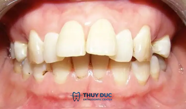 Xem Tướng Đàn Ông Răng Hô: Đặc Điểm, Ý Nghĩa Và Vận Mệnh Chi Tiết Xem Tướng Đàn Ông Răng Hô: Đặc Điểm, Ý Nghĩa Và Vận Mệnh Chi Tiết