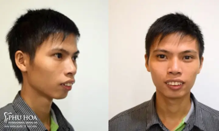 Xem Tướng Đàn Ông Răng Hô: Đặc Điểm, Ý Nghĩa Và Vận Mệnh Chi Tiết Xem Tướng Đàn Ông Răng Hô: Đặc Điểm, Ý Nghĩa Và Vận Mệnh Chi Tiết