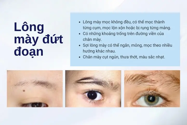 Giải Mã Ý Nghĩa Tướng Lông Mày Đứt Đoạn Theo Nhân Tướng Học Cho Nam Và Nữ Giải Mã Ý Nghĩa Tướng Lông Mày Đứt Đoạn Theo Nhân Tướng Học Cho Nam Và Nữ