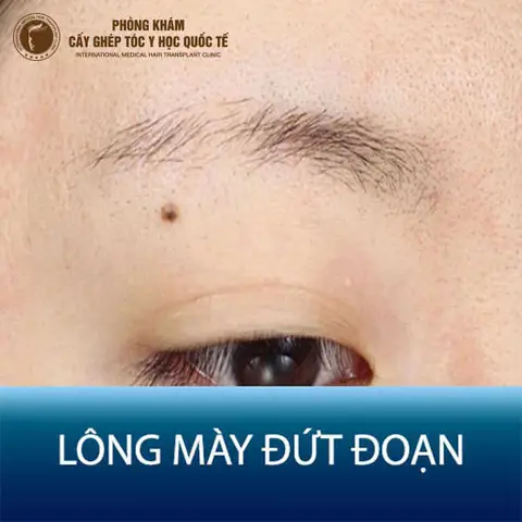 Giải Mã Ý Nghĩa Tướng Lông Mày Đứt Đoạn Theo Nhân Tướng Học Cho Nam Và Nữ Giải Mã Ý Nghĩa Tướng Lông Mày Đứt Đoạn Theo Nhân Tướng Học Cho Nam Và Nữ
