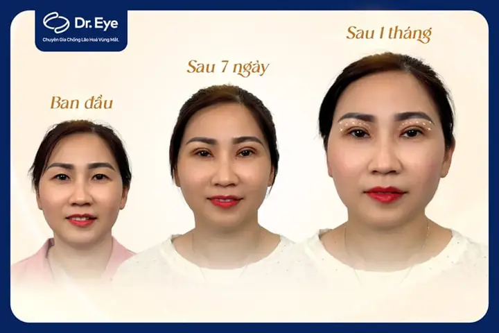 Tướng Mắt Khóe Mắt Hướng Xuống Là Tốt Hay Xấu Và Cách Khắc Phục Như Thế Nào Tướng Mắt Khóe Mắt Hướng Xuống Là Tốt Hay Xấu Và Cách Khắc Phục Như Thế Nào