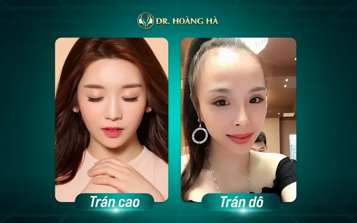Giải Mã Tướng Mặt Tròn Trán Cao: Vận Mệnh, Tính Cách Và Ý Nghĩa Nhân Tướng Học Giải Mã Tướng Mặt Tròn Trán Cao: Vận Mệnh, Tính Cách Và Ý Nghĩa Nhân Tướng Học