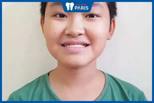 Giải Mã Tướng Miệng Móm: Xấu Hay Đẹp, Tính Cách & Vận Mệnh Nam Nữ Ra Sao? Giải Mã Tướng Miệng Móm: Xấu Hay Đẹp, Tính Cách & Vận Mệnh Nam Nữ Ra Sao?