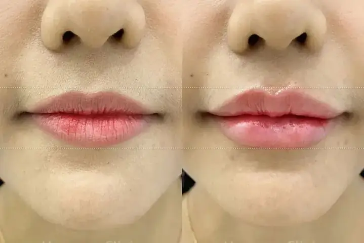 Ý Nghĩa Tướng Môi Nhiều Nếp Nhăn Trong Nhân Tướng Học Và Cách Khắc Phục Ý Nghĩa Tướng Môi Nhiều Nếp Nhăn Trong Nhân Tướng Học Và Cách Khắc Phục