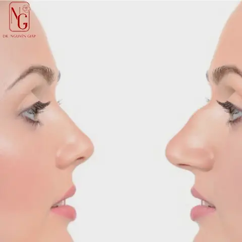 Giải Mã Tướng Mũi Gồ Nhẹ Nam Giới: Ý Nghĩa Nhân Tướng Học, Tốt Hay Xấu Và Cách Khắc Phục Giải Mã Tướng Mũi Gồ Nhẹ Nam Giới: Ý Nghĩa Nhân Tướng Học, Tốt Hay Xấu Và Cách Khắc Phục