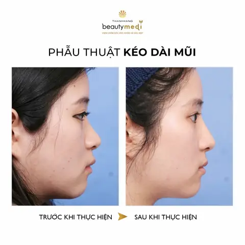 Giải Nghĩa Tướng Mũi Hếch Phụ Nữ Trong Nhân Tướng Học Và Cách Khắc Phục Giải Nghĩa Tướng Mũi Hếch Phụ Nữ Trong Nhân Tướng Học Và Cách Khắc Phục