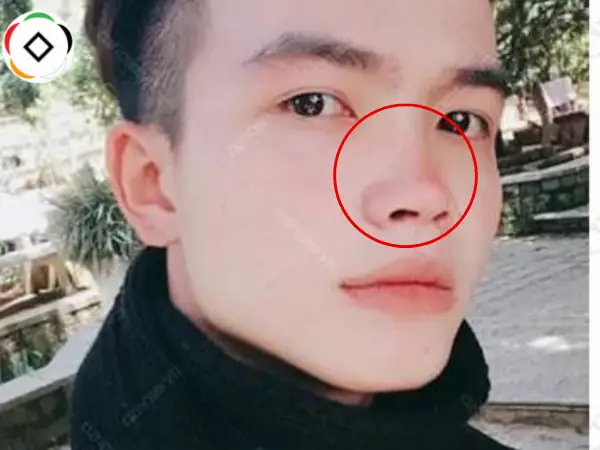 Tổng Hợp Tướng Mũi Nghèo Hèn: 17+ Đặc Điểm Nhận Diện, Phân Biệt Nam/nữ & So Sánh Tướng Mũi Giàu Sang