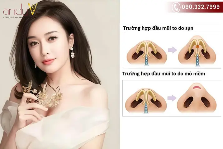 Tướng Mũi Sư Tử (mũi Lân): Đặc Điểm Nhận Diện, Ý Nghĩa Nhân Tướng Nam Nữ & Có Nên Phẫu Thuật Thẩm Mỹ Không? Tướng Mũi Sư Tử (mũi Lân): Đặc Điểm Nhận Diện, Ý Nghĩa Nhân Tướng Nam Nữ & Có Nên Phẫu Thuật Thẩm Mỹ Không?
