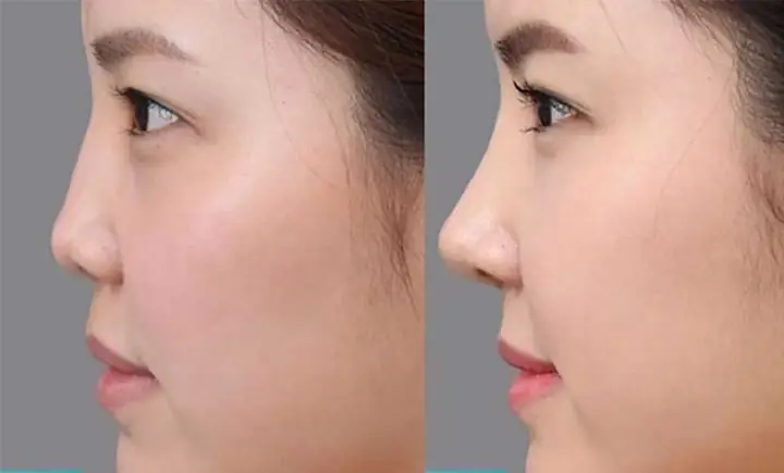 Xem Tướng Mũi To Tẹt: Đặc Điểm, Ý Nghĩa Tướng Số Tốt Xấu Và Cách Khắc Phục Xem Tướng Mũi To Tẹt: Đặc Điểm, Ý Nghĩa Tướng Số Tốt Xấu Và Cách Khắc Phục
