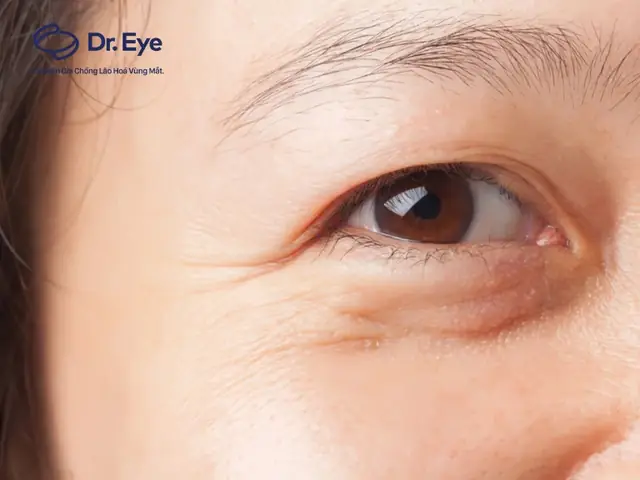 Giải Mã Tướng Nếp Nhăn Đuôi Mắt: 5 Kiểu Chính, Ý Nghĩa Tính Cách & Vận Mệnh Nam Nữ Giải Mã Tướng Nếp Nhăn Đuôi Mắt: 5 Kiểu Chính, Ý Nghĩa Tính Cách & Vận Mệnh Nam Nữ
