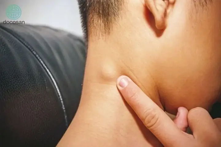 Tướng Người Có Cực U Sau Gáy Là Gì Và Ý Nghĩa Vận Mệnh Theo Nhân Tướng Học