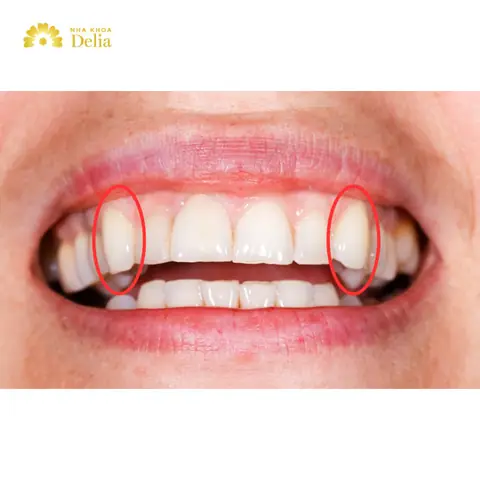 Giải Mã Tướng Người Có Răng Nanh Nhọn: Tính Cách, Vận Mệnh Tốt Hay Xấu? Giải Mã Tướng Người Có Răng Nanh Nhọn: Tính Cách, Vận Mệnh Tốt Hay Xấu?