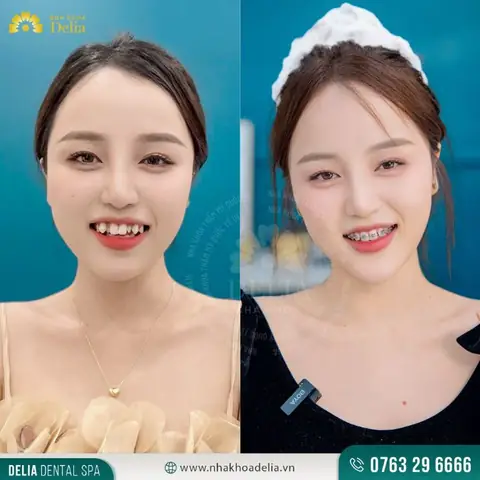 Xem Tướng Người Răng Hô (răng Hổ): Ý Nghĩa, Vận Mệnh Nam/nữ & Cách Khắc Phục Hiệu Quả Xem Tướng Người Răng Hô (răng Hổ): Ý Nghĩa, Vận Mệnh Nam/nữ & Cách Khắc Phục Hiệu Quả