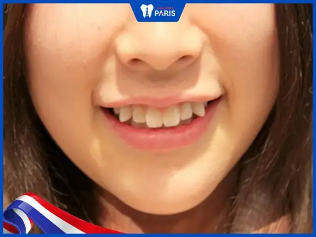 Xem Tướng Người Răng Hô (răng Hổ): Ý Nghĩa, Vận Mệnh Nam/nữ & Cách Khắc Phục Hiệu Quả Xem Tướng Người Răng Hô (răng Hổ): Ý Nghĩa, Vận Mệnh Nam/nữ & Cách Khắc Phục Hiệu Quả