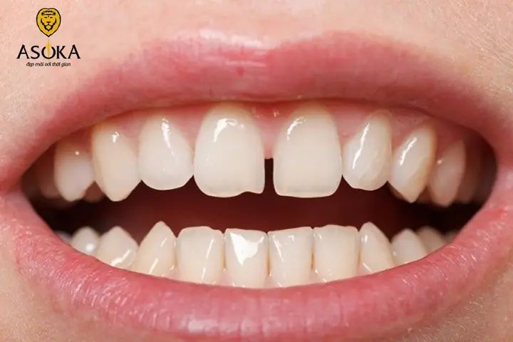 Giải Mã Tướng Phụ Nữ Răng Cửa Thưa: Ý Nghĩa Vận Mệnh Và Tính Cách Giải Mã Tướng Phụ Nữ Răng Cửa Thưa: Ý Nghĩa Vận Mệnh Và Tính Cách